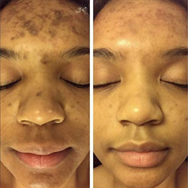 200,000+ Happy CustomersReal Results. Real Women. Real Skin.